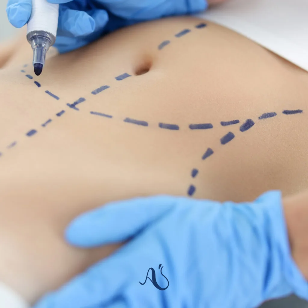 Liposuction (Yağ Aldırma) Hakkında Her Şey: 2026 Modern Vücut Şekillendirme Rehberi